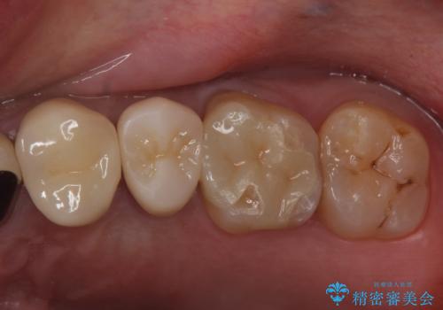 銀の詰め物をやりかえたいの治療後