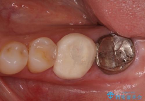 他院で仮歯までしたが、放置していたためセラミック入れたい セラミック治療の治療前