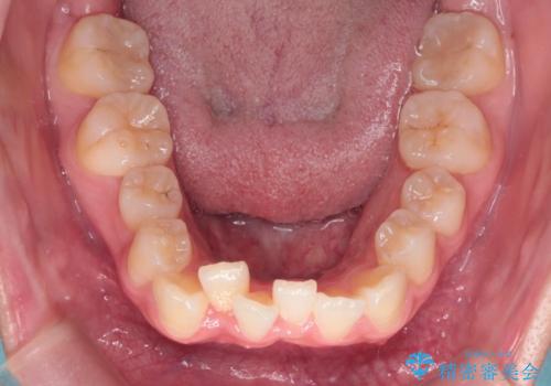 【インビザライン】前歯の凸凹を非抜歯で治療の治療前