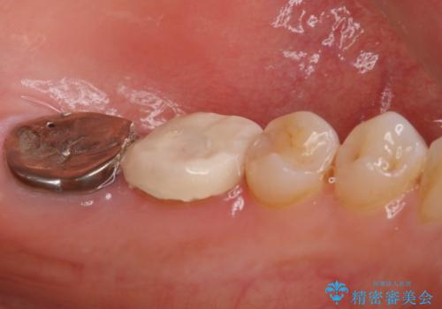他院で仮歯までしたが、放置していたためセラミック入れたい セラミック治療