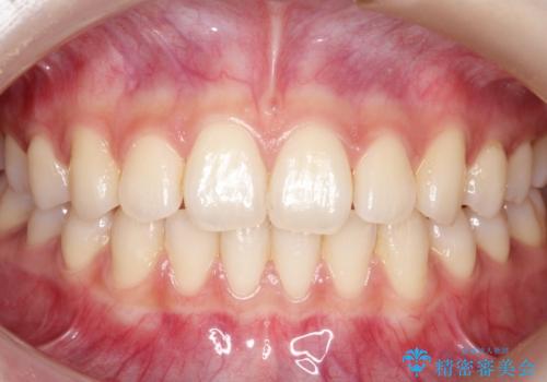 【前歯で噛めません、すきっ歯も気になります】インビザライン治療症例の症例 治療後