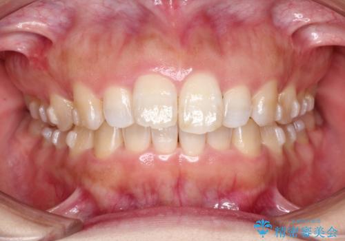 【出っ歯が気になる】インビザライン症例の治療中