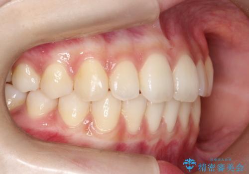 【前歯で噛めません、すきっ歯も気になります】インビザライン治療症例の治療後