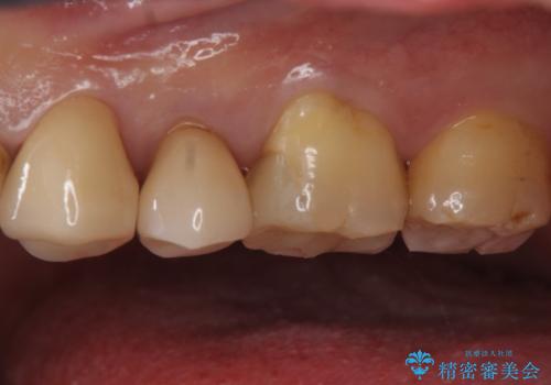 銀の詰め物をやりかえたいの治療後