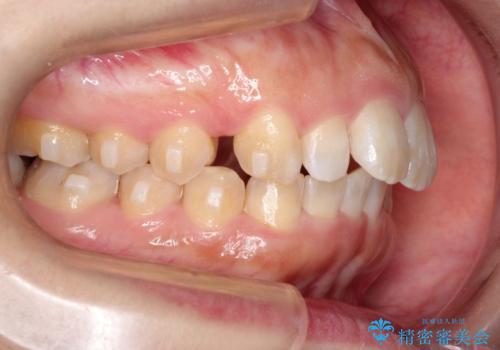 【出っ歯が気になる】インビザライン症例の治療中