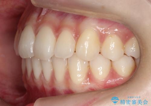 【前歯で噛めません、すきっ歯も気になります】インビザライン治療症例の治療後