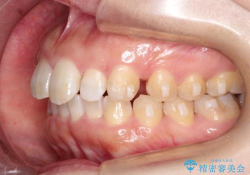 【出っ歯が気になる】インビザライン症例の治療中