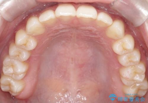 【前歯で噛めません、すきっ歯も気になります】インビザライン治療症例の治療後