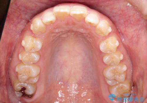 【出っ歯が気になる】インビザライン症例の治療中