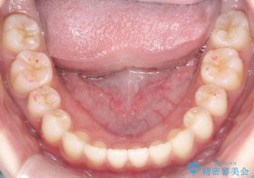 【前歯で噛めません、すきっ歯も気になります】インビザライン治療症例の治療後