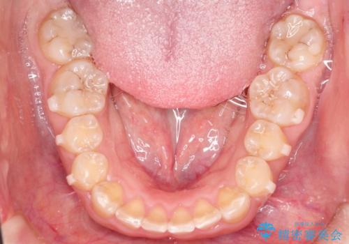 【出っ歯が気になる】インビザライン症例の治療中