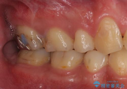 銀の詰め物を白い物にしたいの治療前