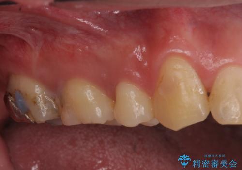 銀の詰め物を白い物にしたいの治療前