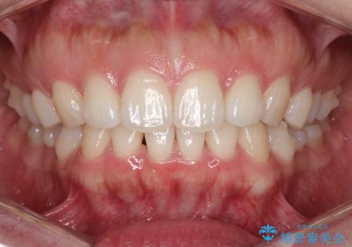 【前歯のガタガタが気になる】インビザライン症例の治療中