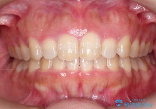 【出っ歯が気になる】インビザライン症例の症例 治療後