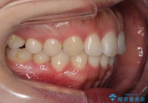 【前歯のガタガタが気になる】インビザライン症例の治療中