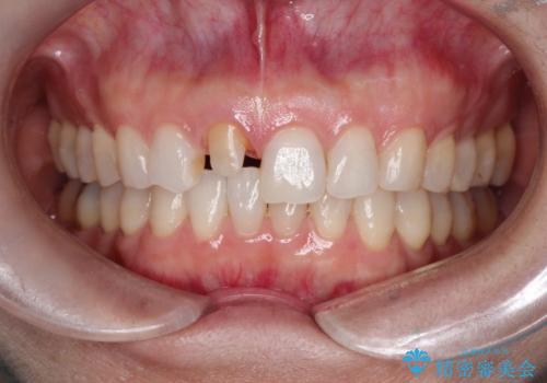 【オールセラミッククラウン】他院で入れた被せものがすぐとれるの治療中