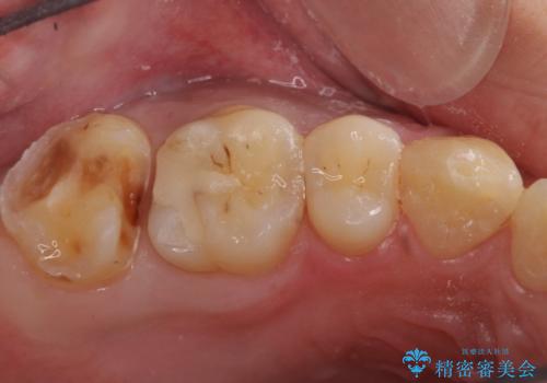 銀の詰め物を白い物にしたいの治療中