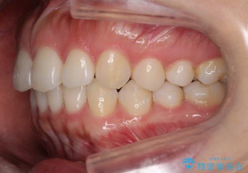 【前歯のガタガタが気になる】インビザライン症例の治療中
