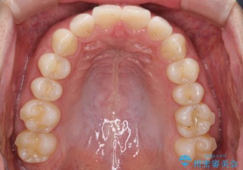 【前歯のガタガタが気になる】インビザライン症例の治療中