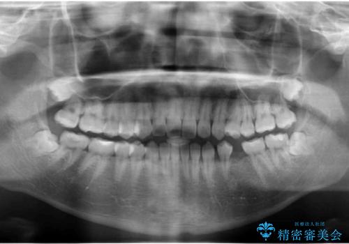生まれつき歯が少ない 20代でインプラント治療の治療前