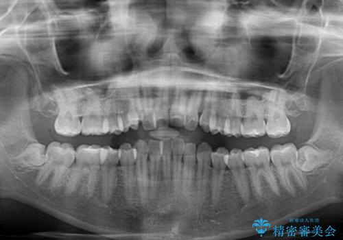 【モニター】八重歯とデコボコをスッキリきれいに ワイヤー装置での抜歯矯正の治療前