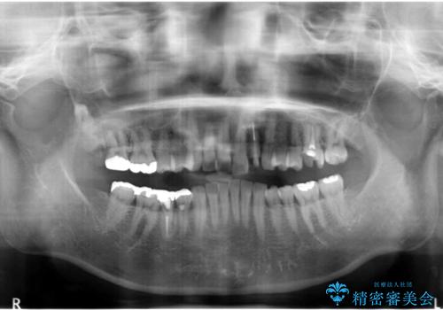 口腔内をメタルフリーにしたいの治療前