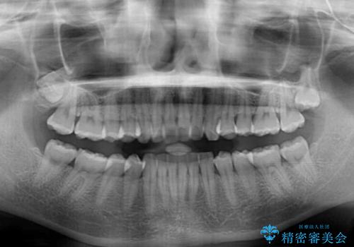 【モニター】飛び出した上顎前歯のワイヤー矯正で改善の治療前