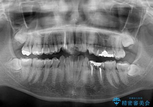 デコボコで磨きにくい前歯をスッキリと インビザライン矯正の治療前