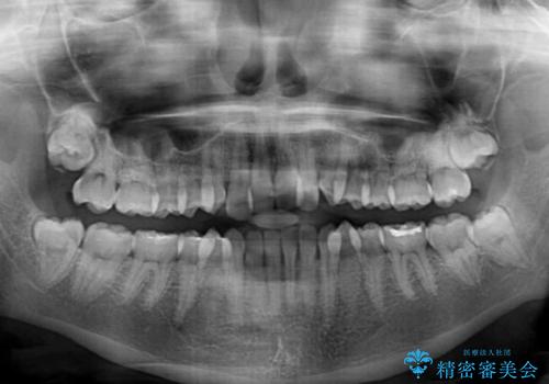 前歯のクロスバイトを短期間で解消 目立たないワイヤー矯正の治療前