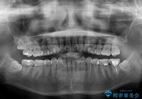 前歯のクロスバイト ワイヤー装置を併用したインビザライン矯正の治療前