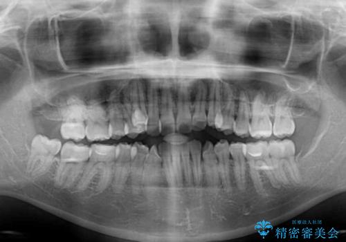 八重歯を抜歯矯正でスッキリと　メタルブラケットでの矯正治療の治療前