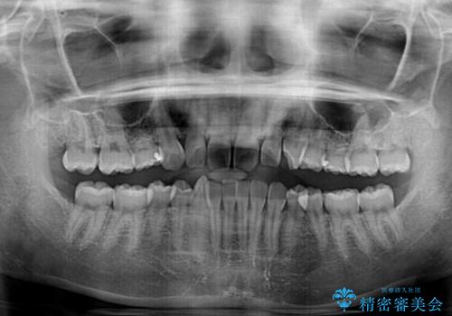 ディープバイトをインビザライン矯正で改善の治療前