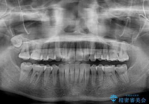 【モニター】飛び出した上顎前歯のワイヤー矯正で改善の治療後