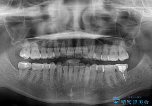 前歯のクロスバイト ワイヤー装置を併用したインビザライン矯正の治療後