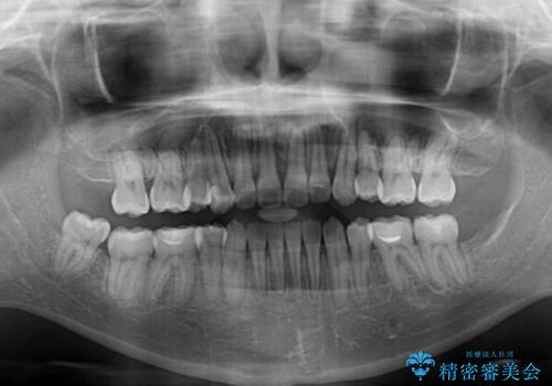 八重歯を抜歯矯正でスッキリと　メタルブラケットでの矯正治療の治療後