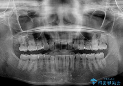ディープバイトをインビザライン矯正で改善の治療後