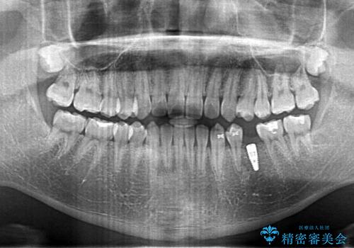生まれつき歯が少ない 20代でインプラント治療の治療中