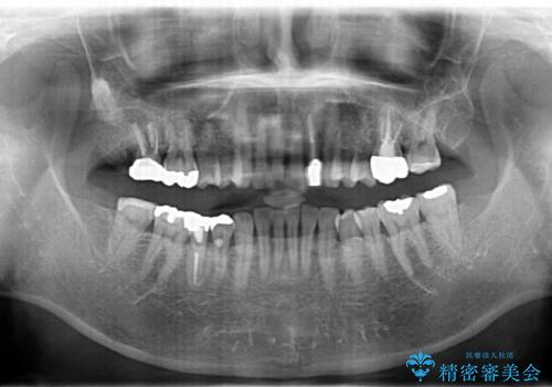 口腔内をメタルフリーにしたいの治療後