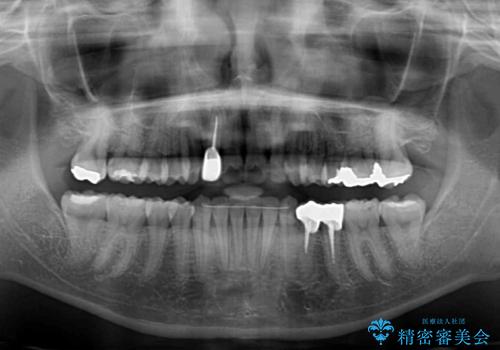 デコボコで磨きにくい前歯をスッキリと インビザライン矯正の治療後