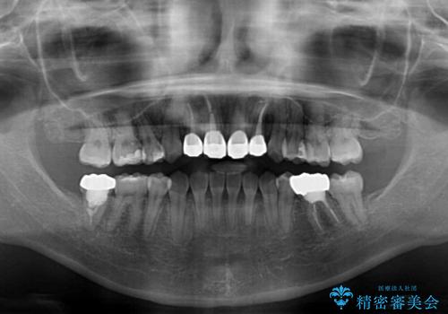 八重歯と開咬を治したい 目立たないハーフリンガル矯正の治療後