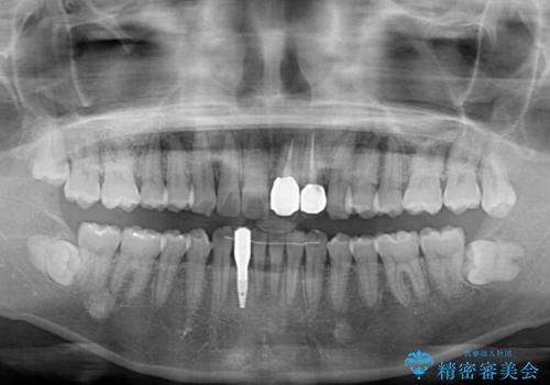 前歯のインプラント治療　折角なので矯正治療できれいな歯並びにの治療後