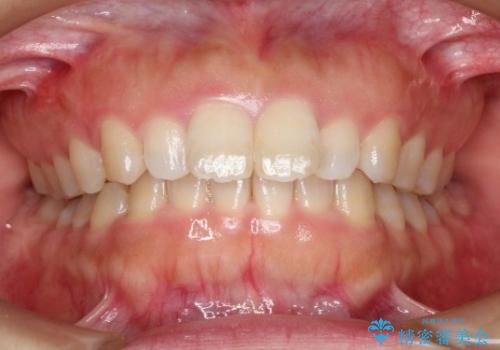 【出っ歯が気になる】インビザライン症例の症例 治療前