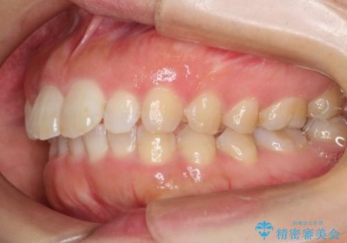 【出っ歯が気になる】インビザライン症例の治療前