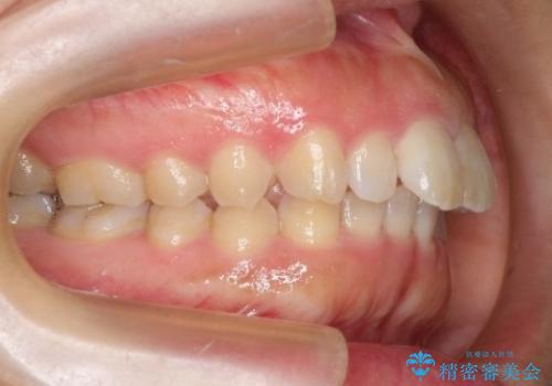 【出っ歯が気になる】インビザライン症例の治療前