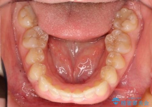 【出っ歯が気になる】インビザライン症例の治療前