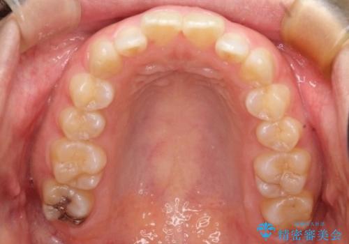 【出っ歯が気になる】インビザライン症例の治療前