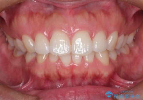 【前歯のガタガタが気になる】インビザライン症例の症例 治療前