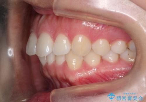 【前歯のガタガタが気になる】インビザライン症例の治療前