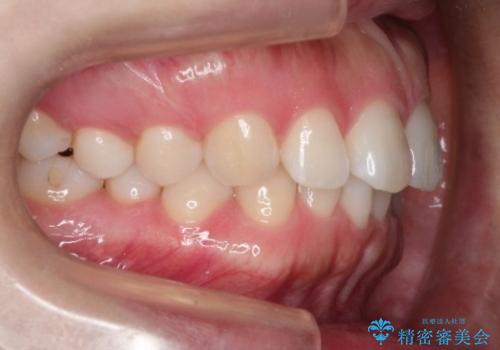 【前歯のガタガタが気になる】インビザライン症例の治療前